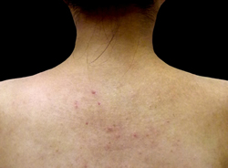 背中のブツブツ